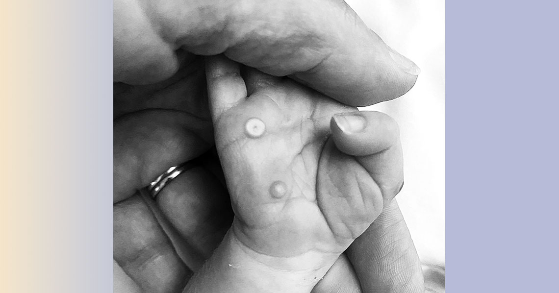 Lesões causadas por Mpox em mãos de um recém-nascido